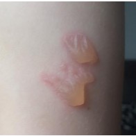 Lax beetle blisters