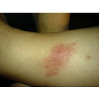 Sandfly bites